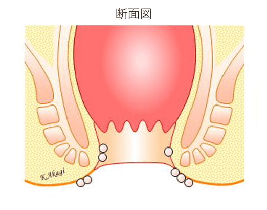 毛巣洞の様子断面